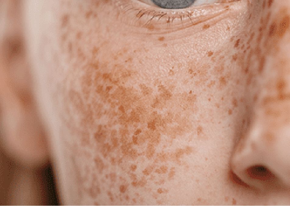 Visita el Centro Dermatológico del Dr Iván Diazgranados en Barranquilla Especialista en dermatología clínica y medicina estética. Expertos en tratamientos como ácido hialurónico, toxina botulínica (Botox) y bioestimuladores de colágeno