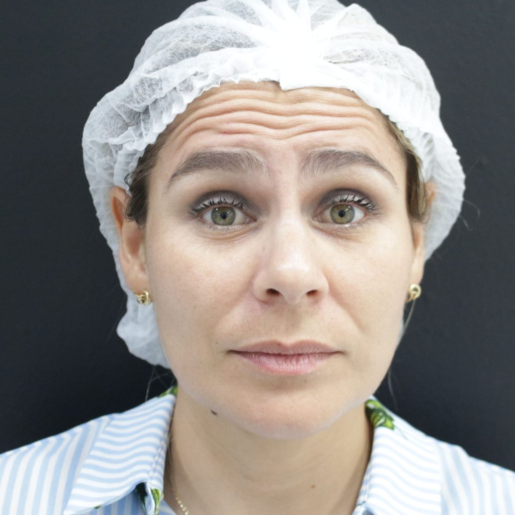 Aplicación de toxina botulínica