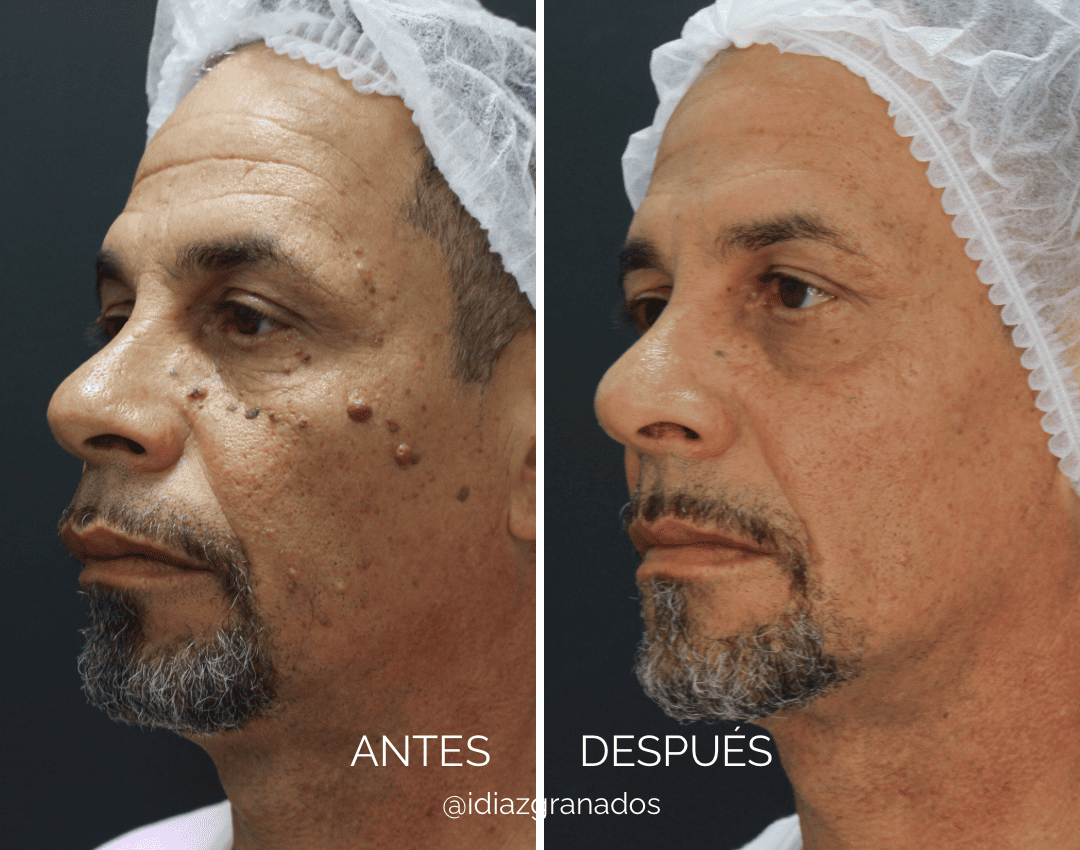 Visita el Centro Dermatológico del Dr Iván Diazgranados en Barranquilla Especialista en dermatología clínica y medicina estética. Expertos en tratamientos como ácido hialurónico, toxina botulínica (Botox) y bioestimuladores de colágeno