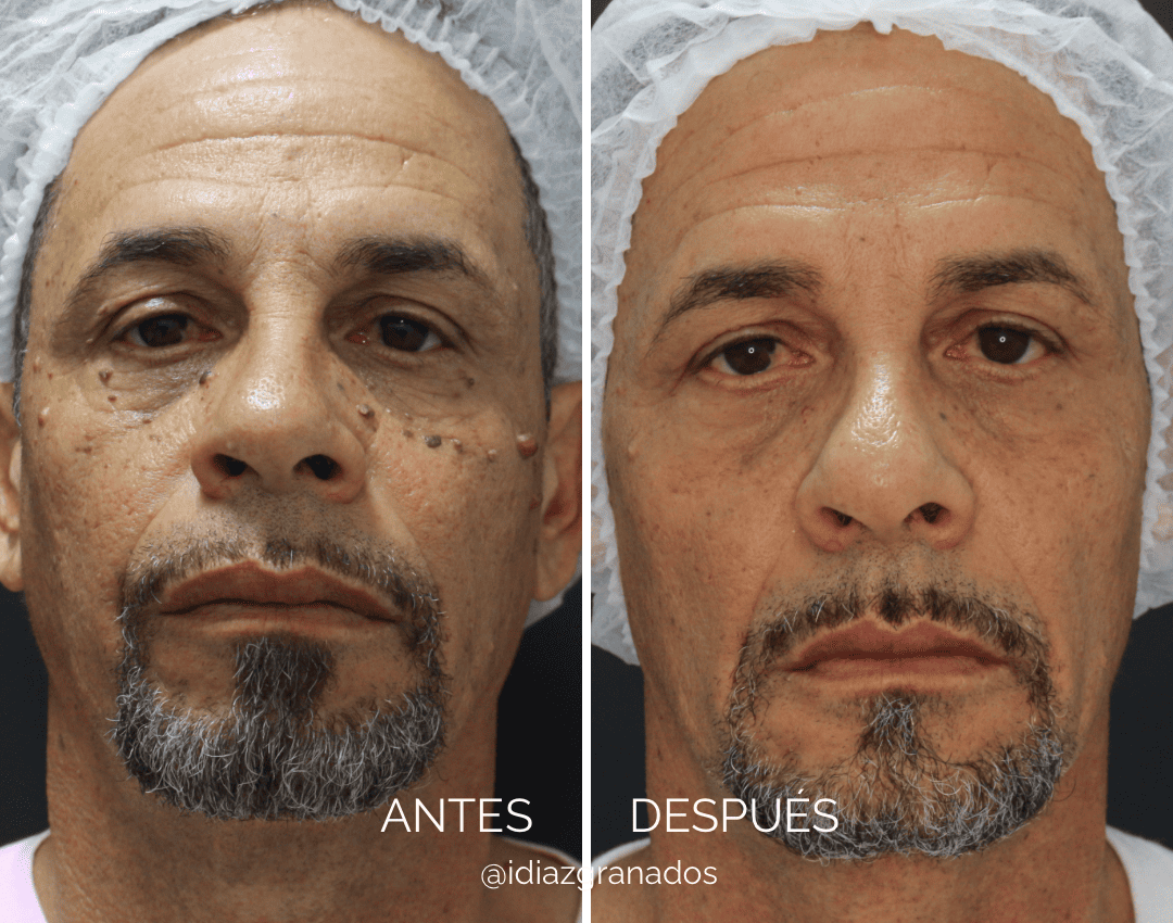 Visita el Centro Dermatológico del Dr Iván Diazgranados en Barranquilla Especialista en dermatología clínica y medicina estética. Expertos en tratamientos como ácido hialurónico, toxina botulínica (Botox) y bioestimuladores de colágeno