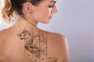 Eliminar tatuajes