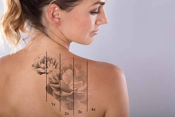 Eliminar tatuajes