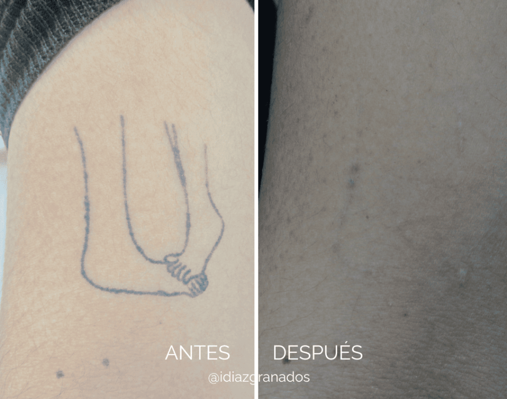 ANTES - 15 (1) (1) Eliminación de tatuajes