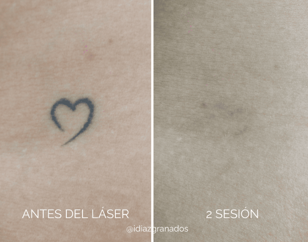ANTES - 26 (1) (1) Eliminación de tatuajes