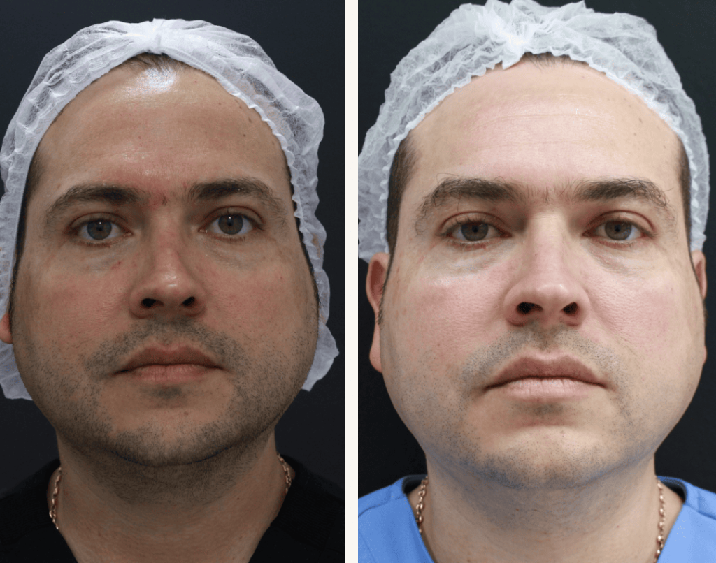 ROSACEA _ WILLIAN BAQUERO (1) tratamientos para la rosácea