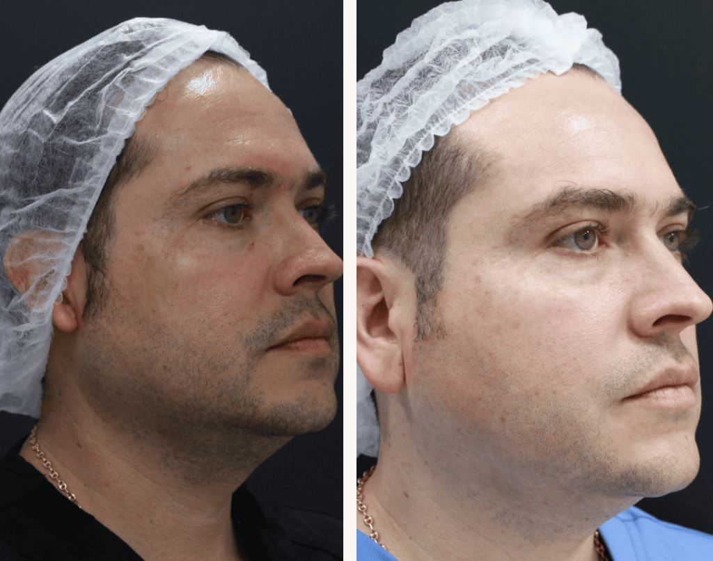 ROSACEA _ WILLIAN BAQUERO(1) (2) tratamientos para la rosácea