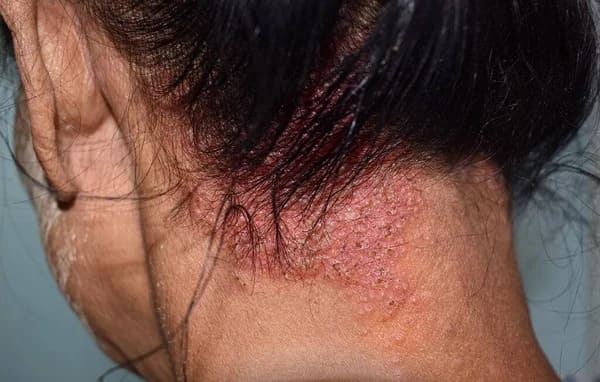 depositphotos_490378392-stock-photo-seborrheic-dermatitis-fungal-skin-infection (1) dermatitis seborreíca