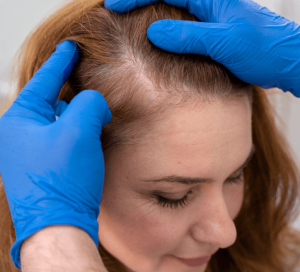 Calvicie o alopecia