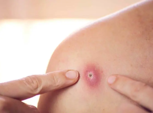 Qué es la foliculitis