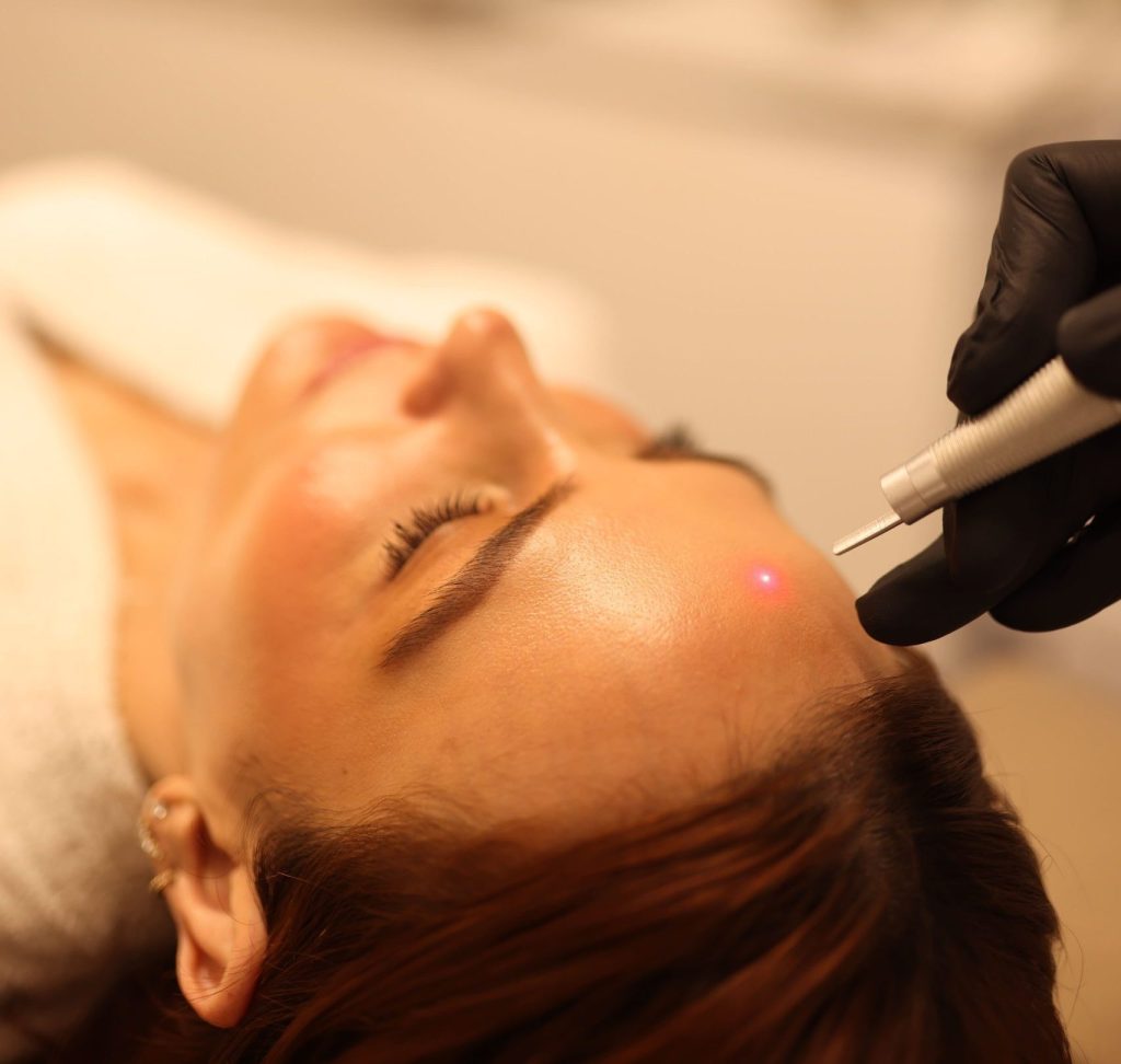 Laser CO2 fraccionado