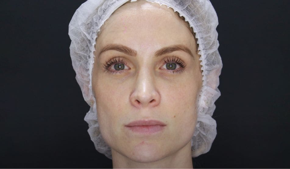 bioestimuladores de colágeno