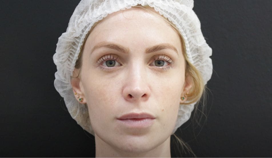 bioestimuladores de colágeno